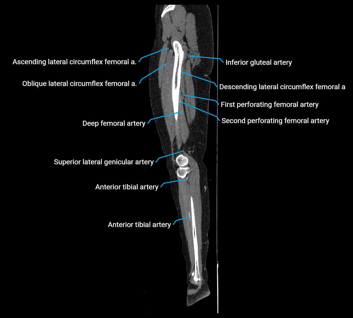 CTA lower limb sagittal cross sectional anatomy labelled image _53 (3).webp